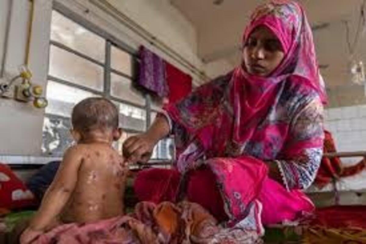Another kid suffering from Measles in Bangladesh